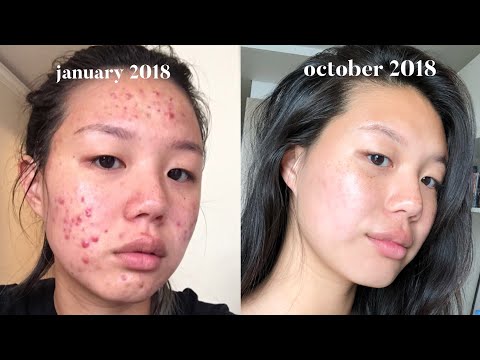 Acne Skincare Routine FINALLY. - HealthTricksPlace.com