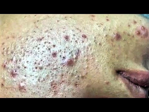 Satisfying Video Acne, Blackheads Removal Skin Care and Relaxing Sleep ...