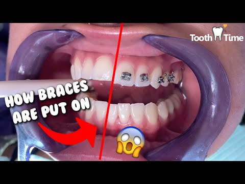 How Braces are put on - Dental Braces Tooth Time Family Dentistry New ...