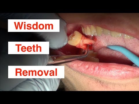 Wisdom Teeth Removal - HealthTricksPlace.com