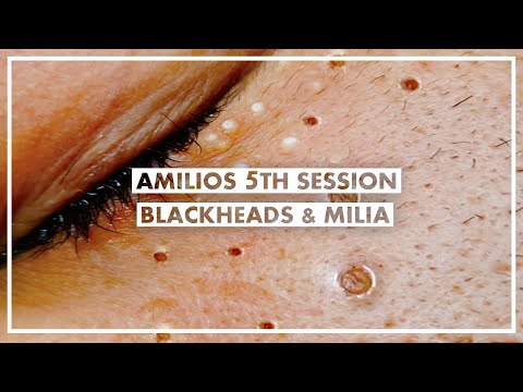 Amilios 5th Session - Blackheads And Milia Extraction On The Face