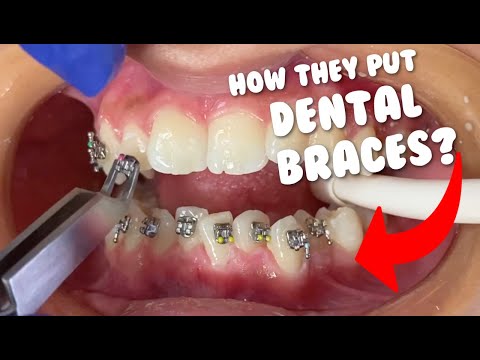 How they put braces - Dental Braces Tooth Time Family Dentistry New ...